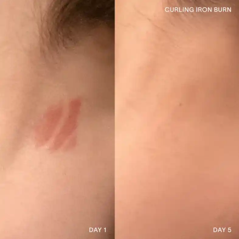 Before and after results using a Healing Balm on butt crack skin